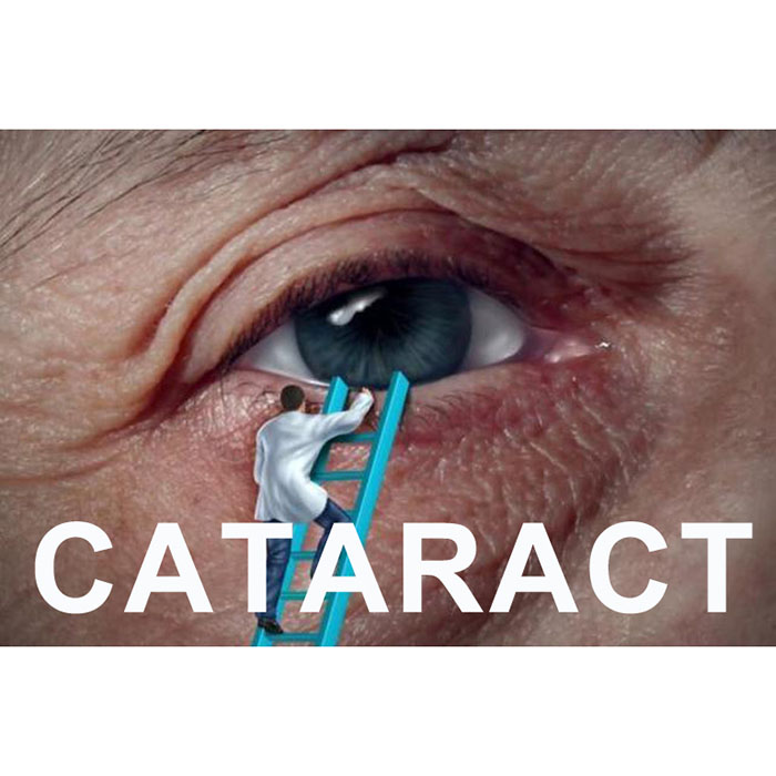 Forwarding cataract FAQ, need to give patients popular science to use