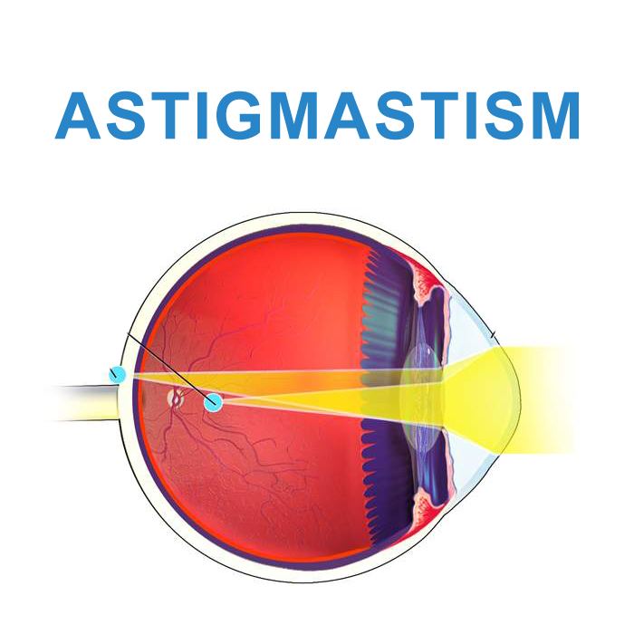 Astigmatism (Theory, Pathophysiology )