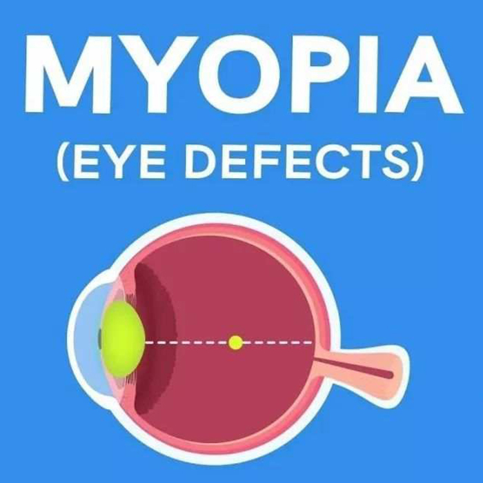 Myopia prevention and control (Myopia-Nearsightedness)